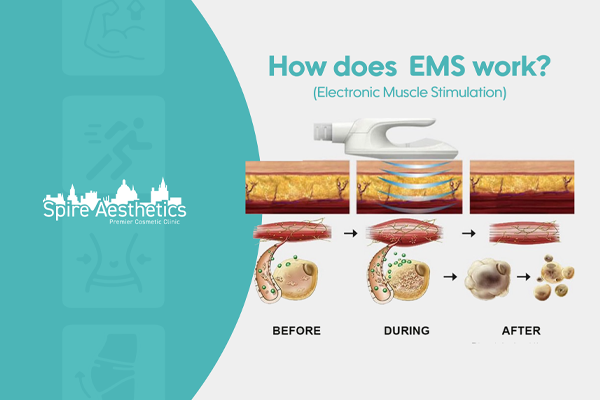 EMS treatment for post pregnancy weight loss treatment Westbury