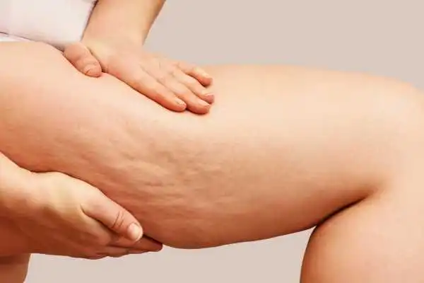 Image of woman showing leg with cellulite Westbury