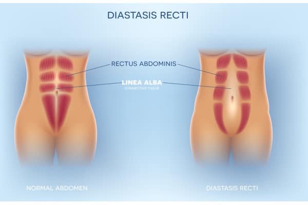 What Non-Surgical Options Are Available for Diastasis Recti Westbury?