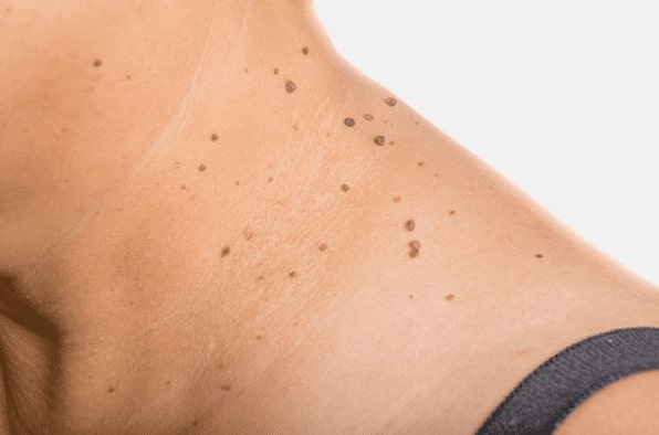 Are you looking for easy skin tag removal Westbury - then contact Spire today!