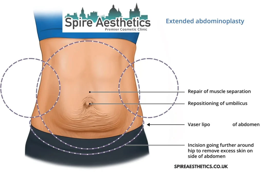 Understanding Loose Skin After Gastric Band Westbury Surgery and HIFU Treatment 