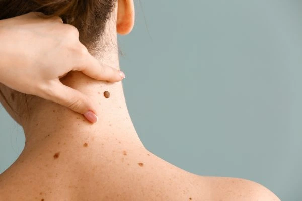 Prices and promotions for blemish removal Westbury contact our team today!