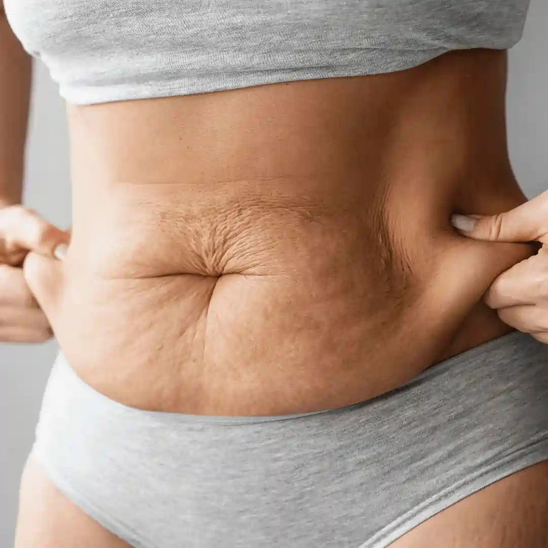Is It Normal to Have Loose Skin After Pregnancy Westbury?