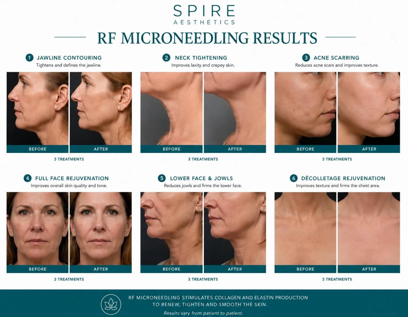 RF Microneedling Skin tightening Westbury results
