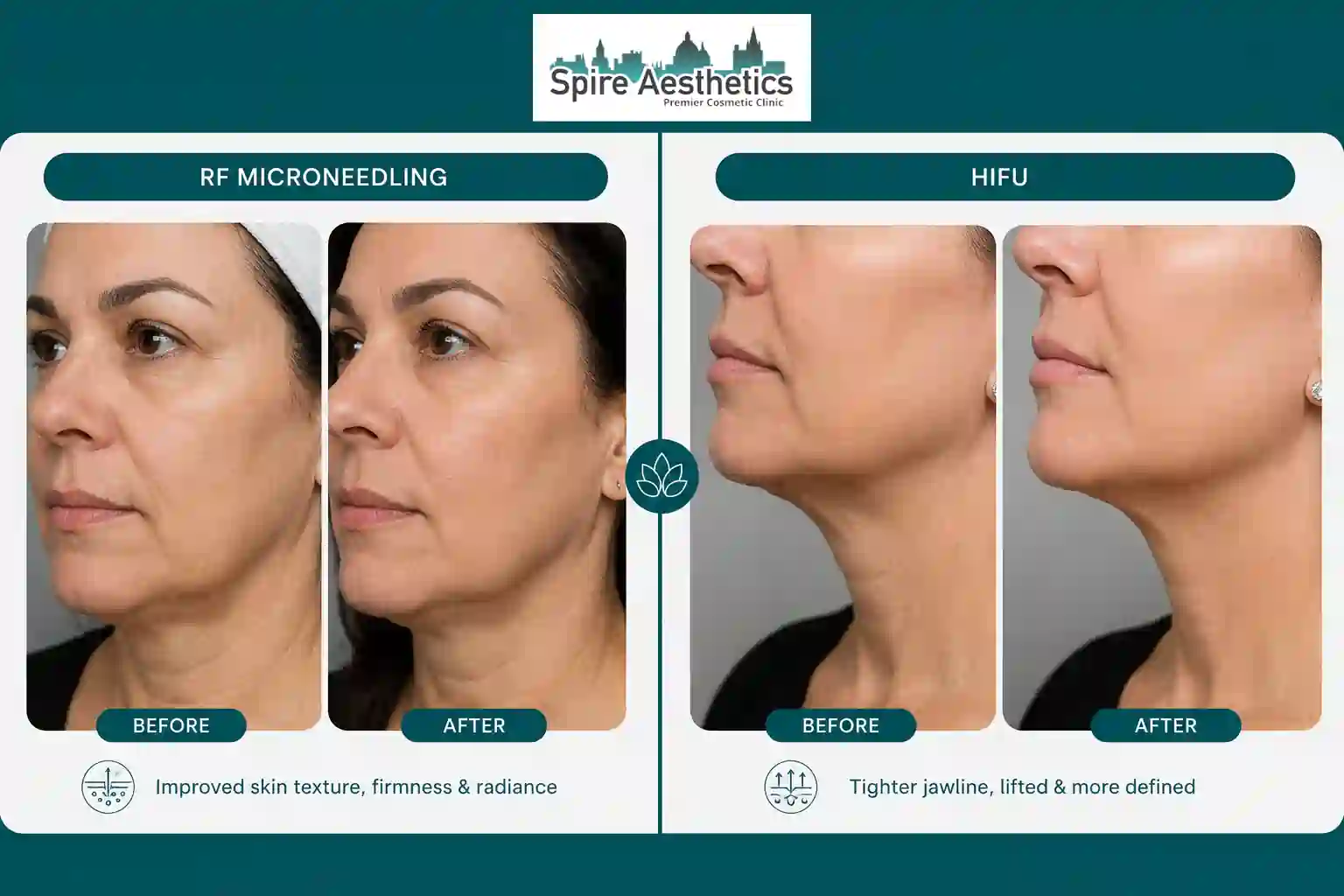 Can RF Microneedling and HIFU Be Combined Westbury?
