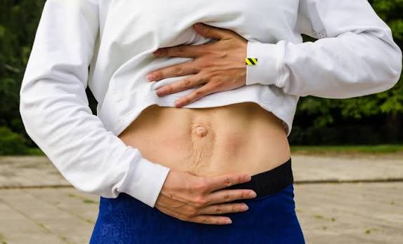 When Could Diastasis Recti Be the Missing Piece of the Puzzle Westbury?