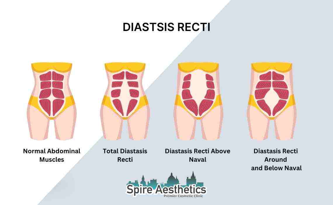 Is Non-Surgical Diastasis Recti Treatment Right for You? Common Concerns Answered Westbury